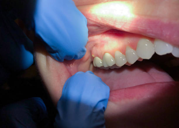 Best Emergency Dental Care for Broken or Chipped Teeth in Mountain Top, PA